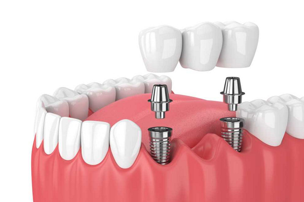 Trồng răng implant tại Đà Nẵng là một trong những dịch vụ chuyên sâu được lựa chọn nhiều nhất tại nơi đây.