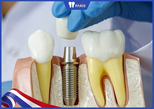 Nha khoa Paris Đà Nẵng là địa chỉ trồng răng implant tại Đà Nẵng tiếp theo mà ReviewNao muốn giới thiệu.